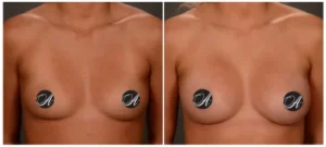 Young patient of Dr. Alexander’s, shown before and 3 months after breast augmentation with implants (front view)